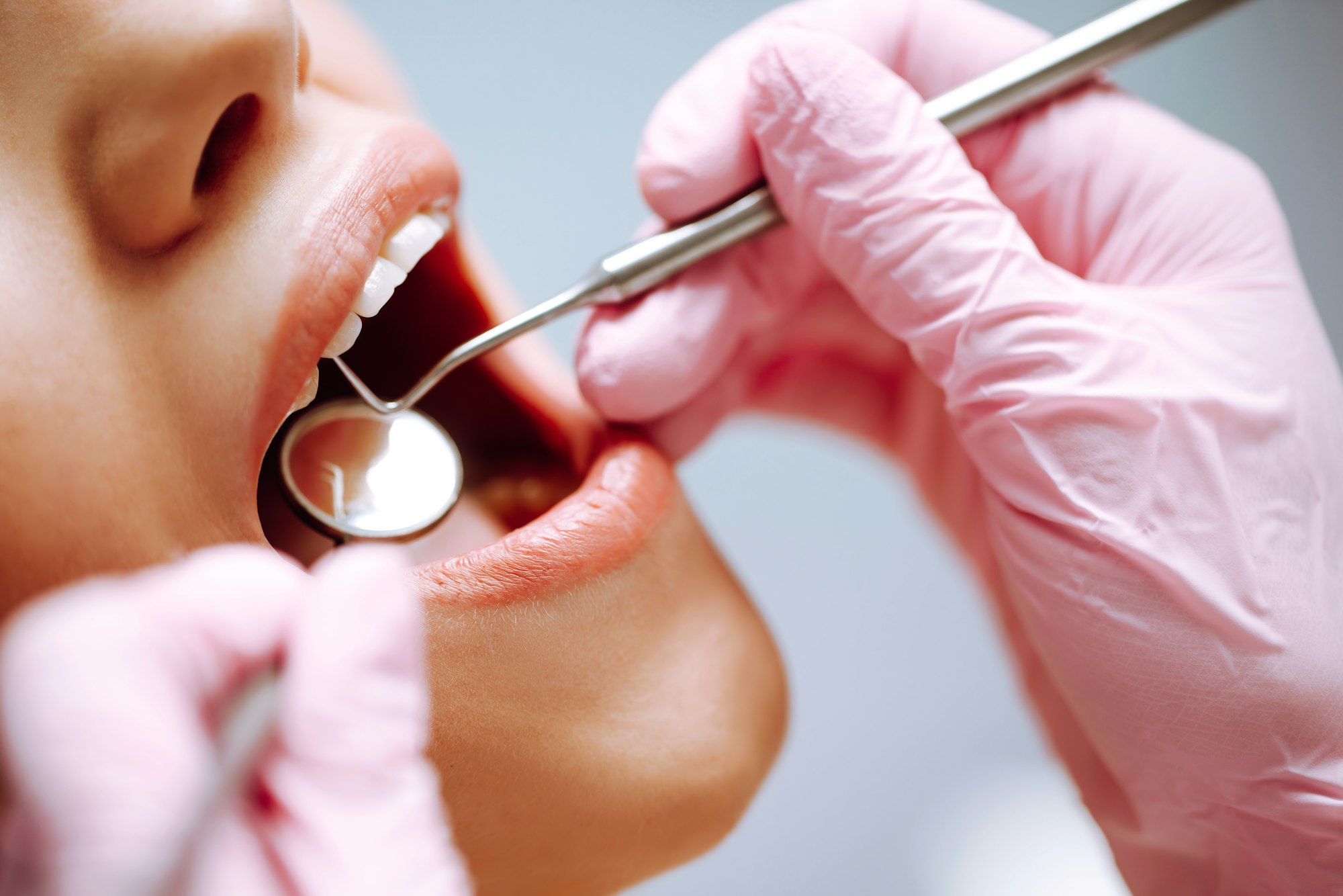 young-woman-at-the-dentist-s-chair-during-a-dental-procedure-overview-of-dental-caries-prevention-.jpg